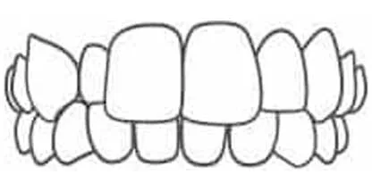 Cross Bite