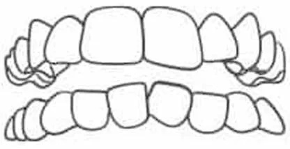 Crowded Teeth Treatment