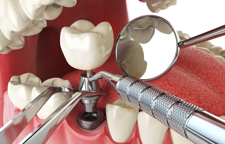 Dental Implants in Lahore