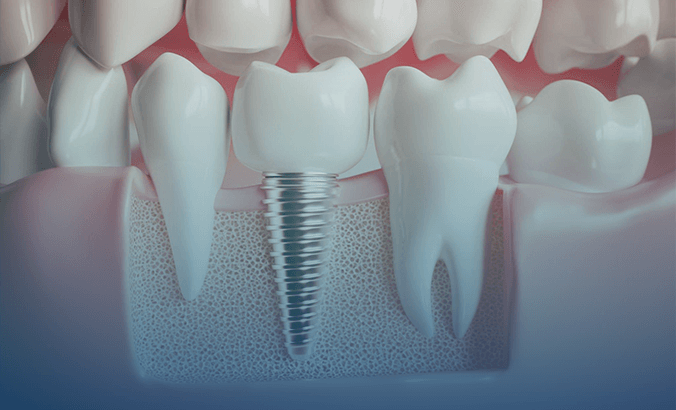Dental Implants Surgery
