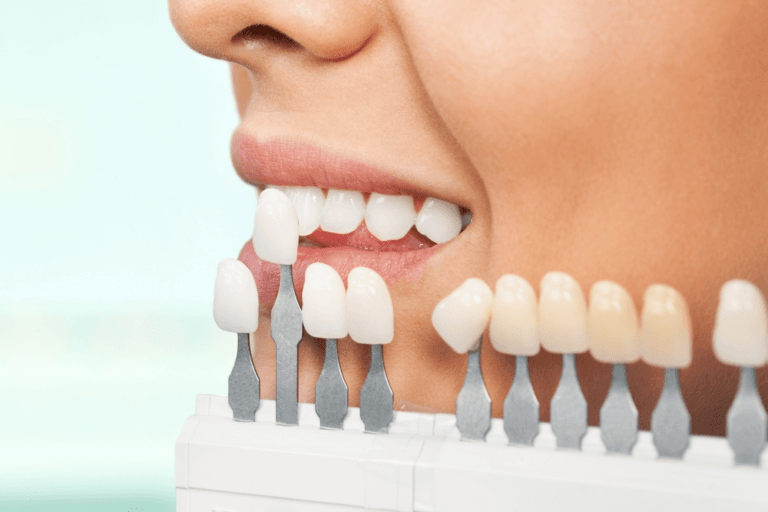veneers vs lumineers