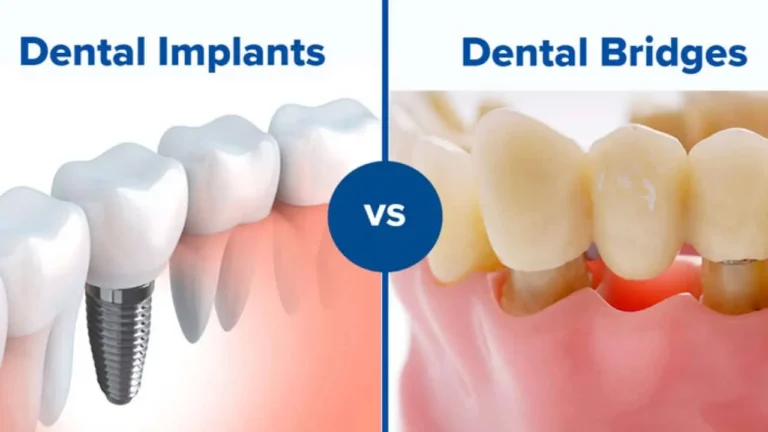 Dental Implants and Bridges