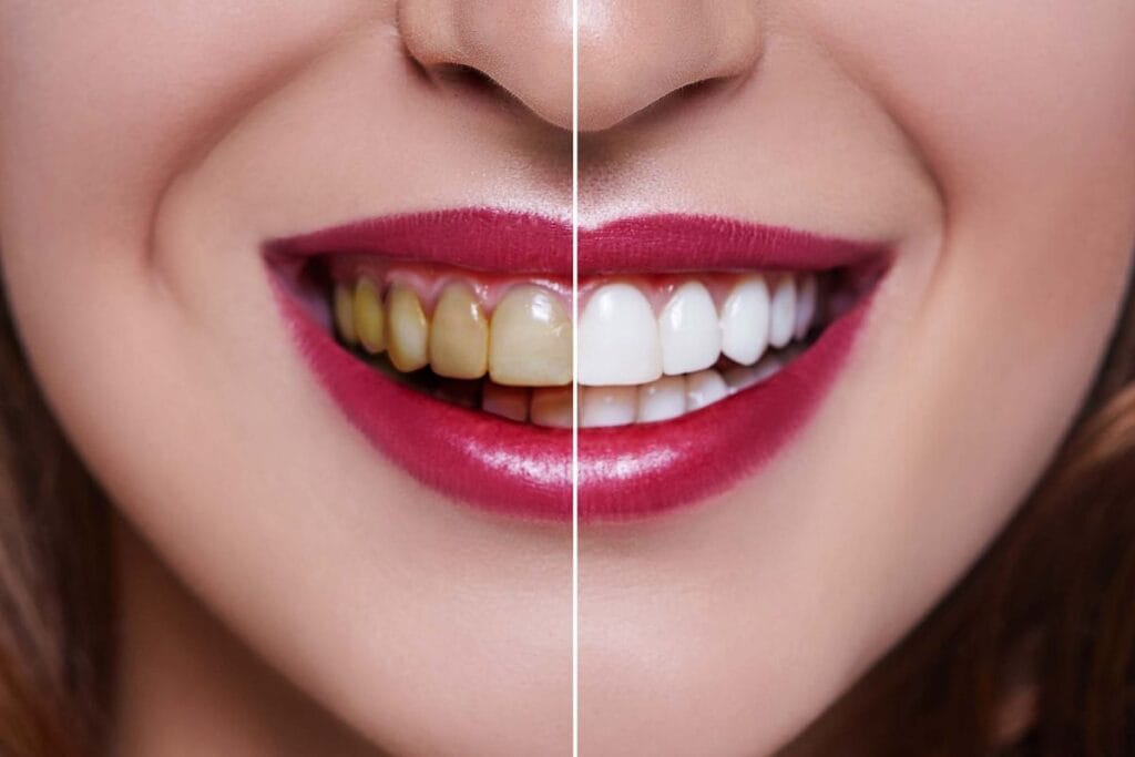 Teeth whitening