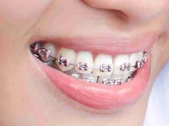Orthodontic Braces
