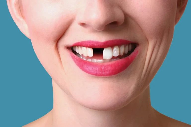 missing teeth solutions