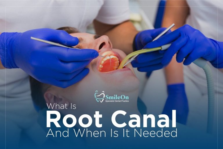 What is Root Canal Treatment