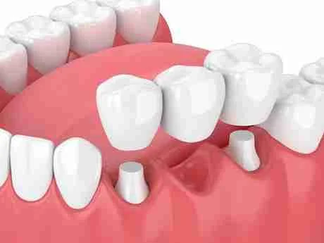 dental crown specialist
