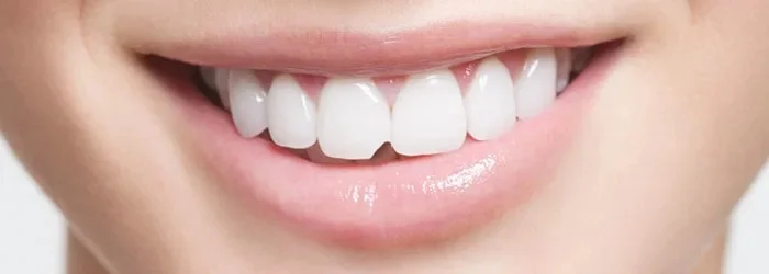 chipped tooth treatment