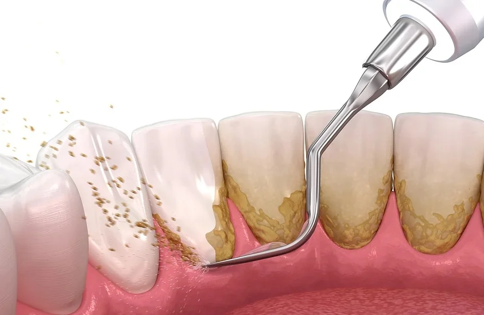 teeth scaling in Lahore