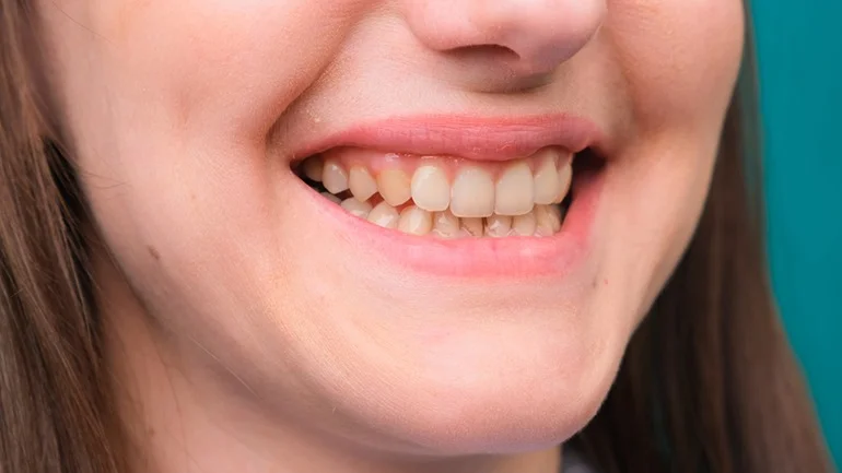 yellow teeth treatment
