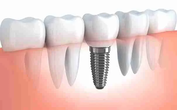 Dental Implants Lahore