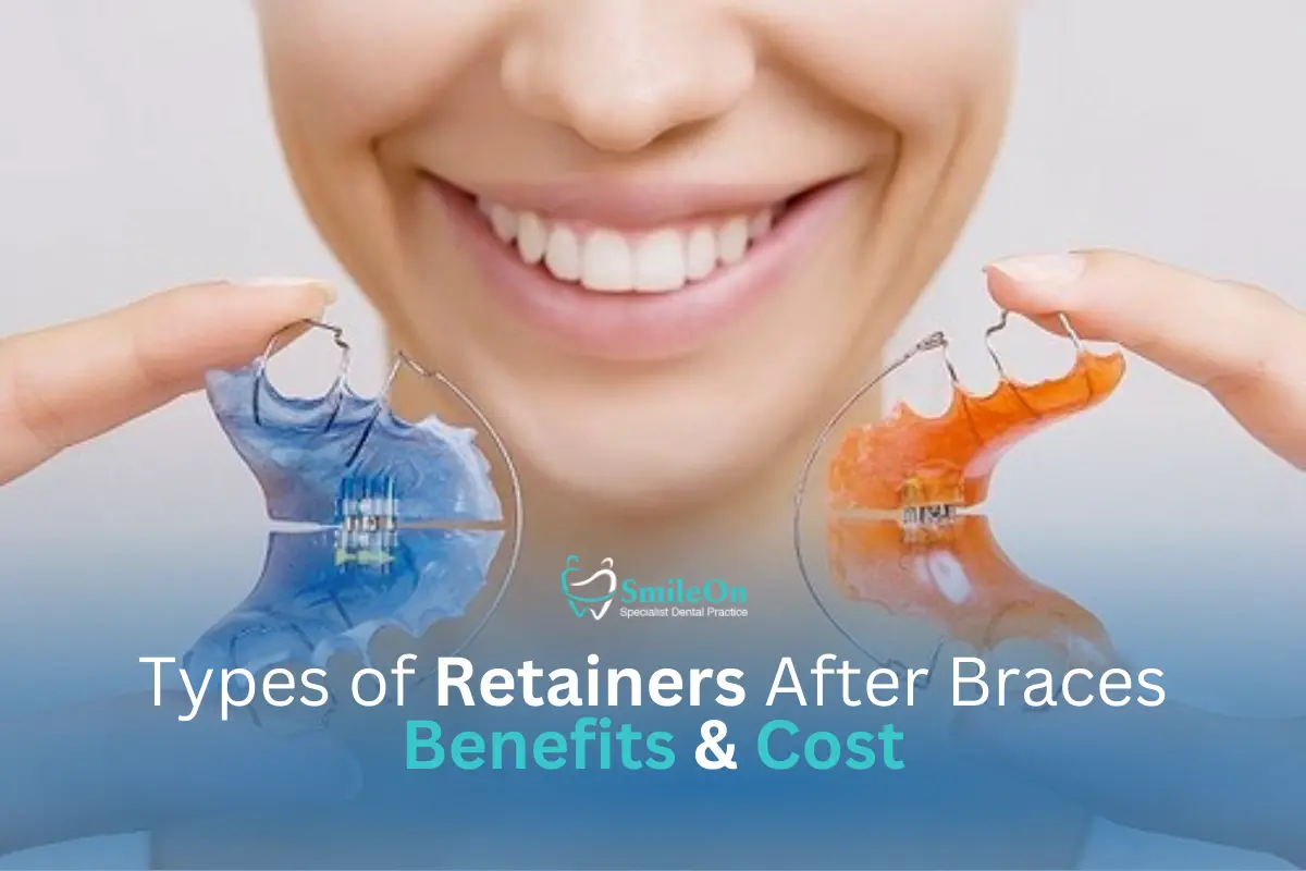 Retainers After Braces