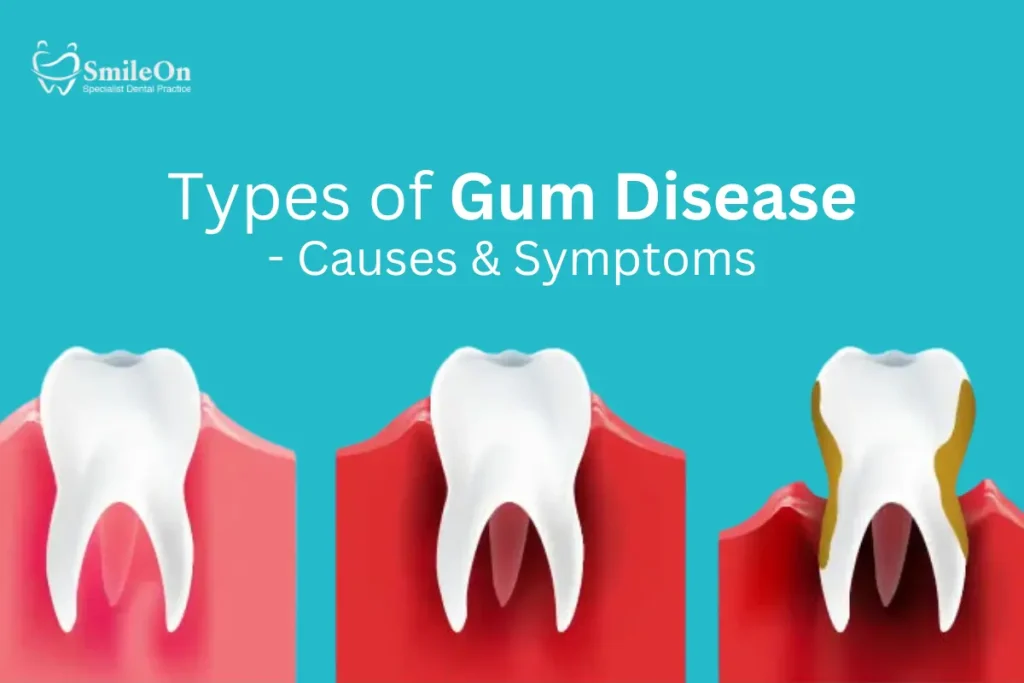 Types of Gum Disease