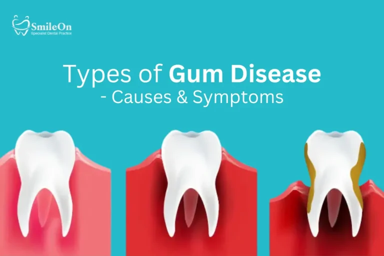 Types of Gum Disease