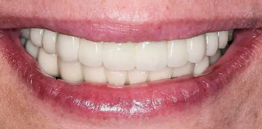 implants all on six after