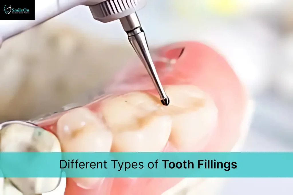 Types of Tooth Fillings