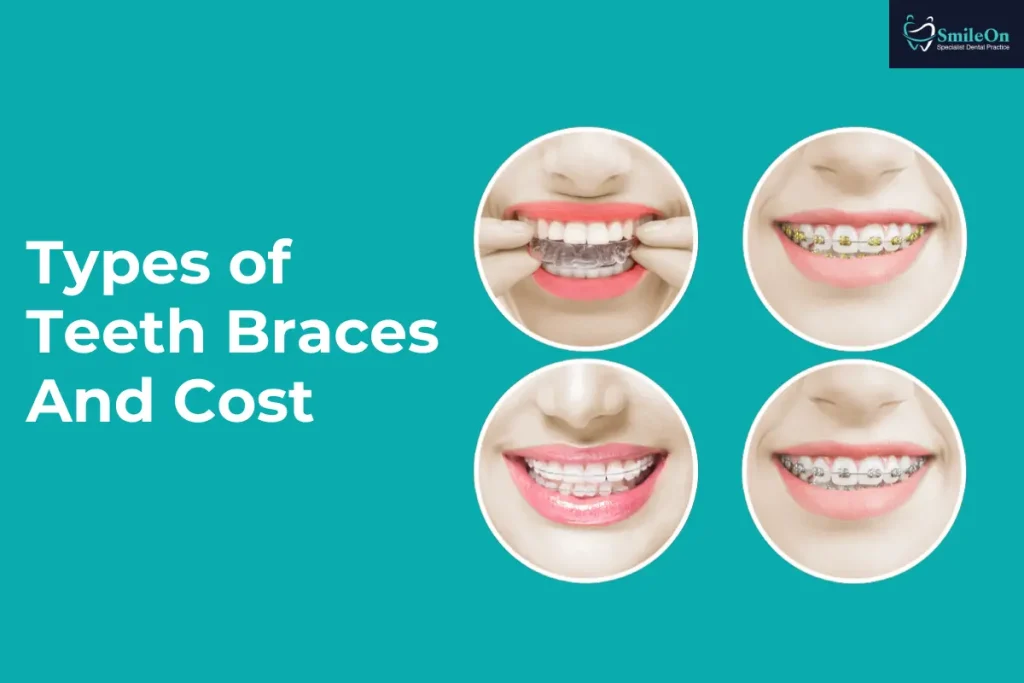 Types of Teeth Braces