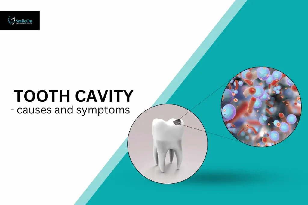 What is Tooth Cavity