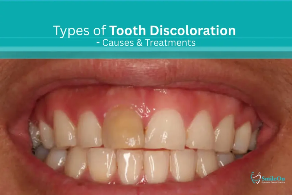 tooth discoloration