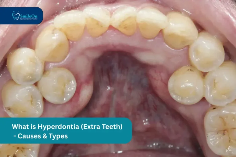what is hyperdontia