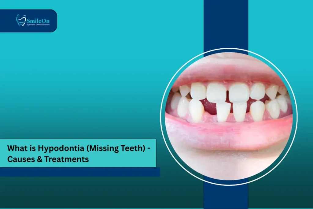 hypodontia