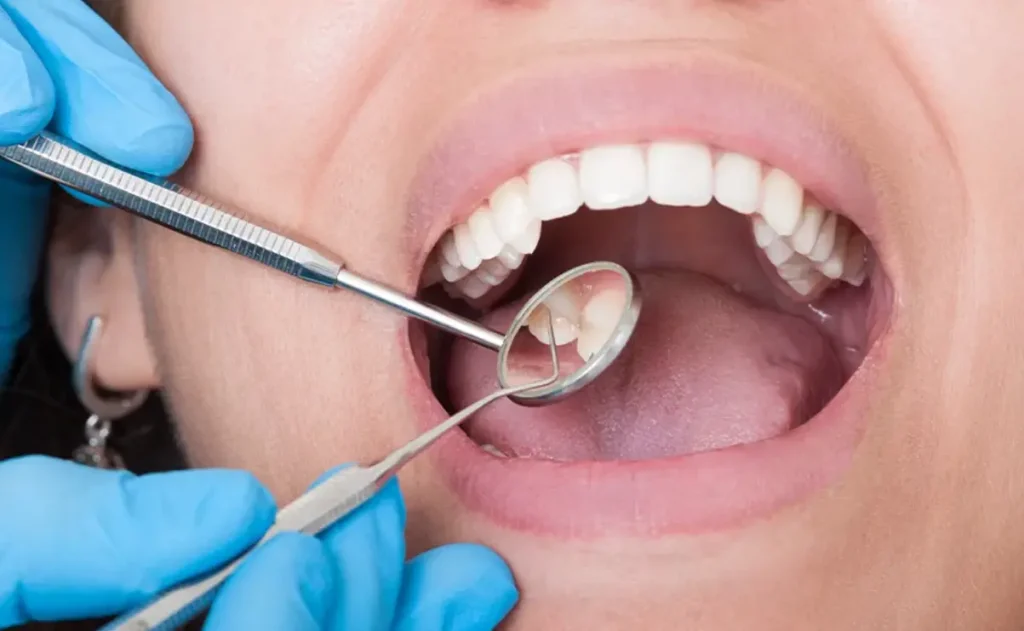 After Tooth Extraction
