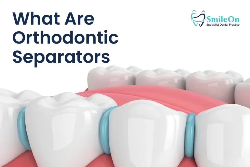 Orthodontic Separators