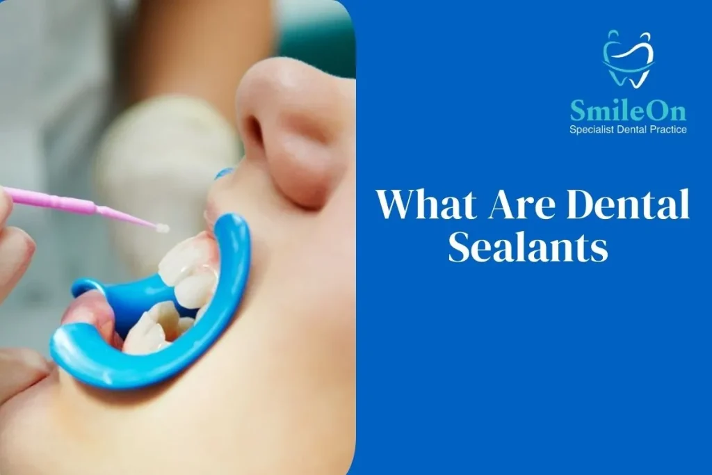 Dental Sealants