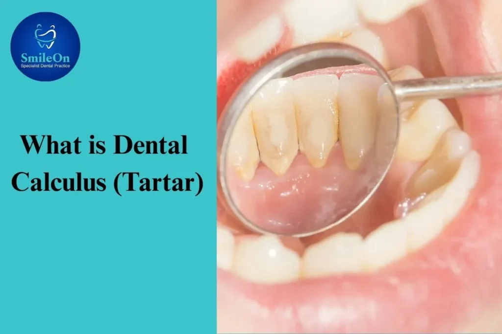 Dental Calculus