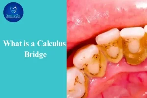 Calculus Bridge