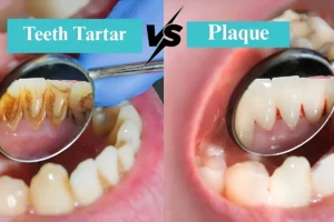 Tartar vs Plaque