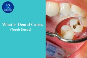 Dental Caries