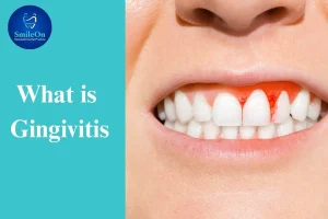 Gingivitis