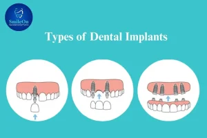 Types of Dental Implant