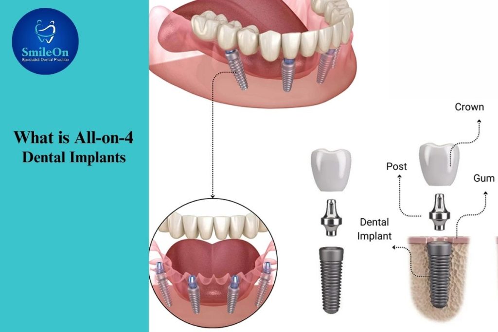 All on 4 Dental Implants