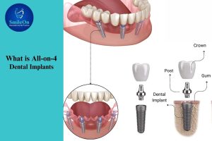 All on 4 Dental Implants