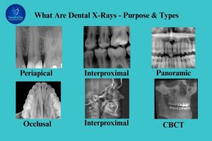 Dental X-Rays