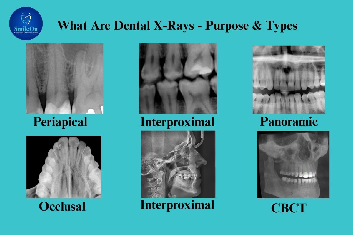 Dental X-Rays