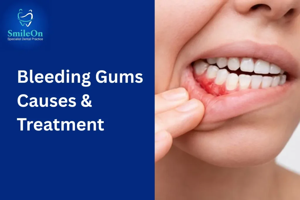 Bleeding Gums Causes & Treatment