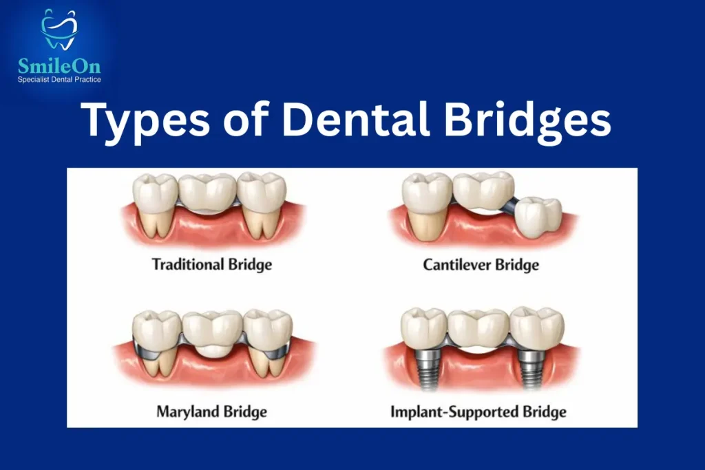 Types of Dental Bridges