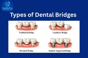 Types of Dental Bridges