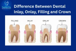 Dental Inlay and Onlay