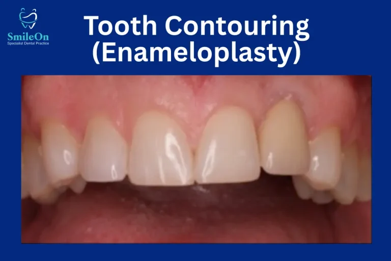 Tooth Contouring