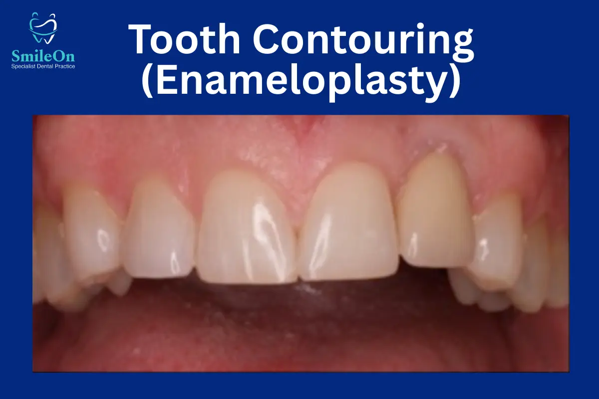 Tooth Contouring