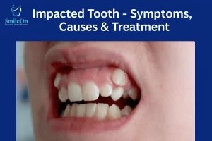 Impacted Tooth