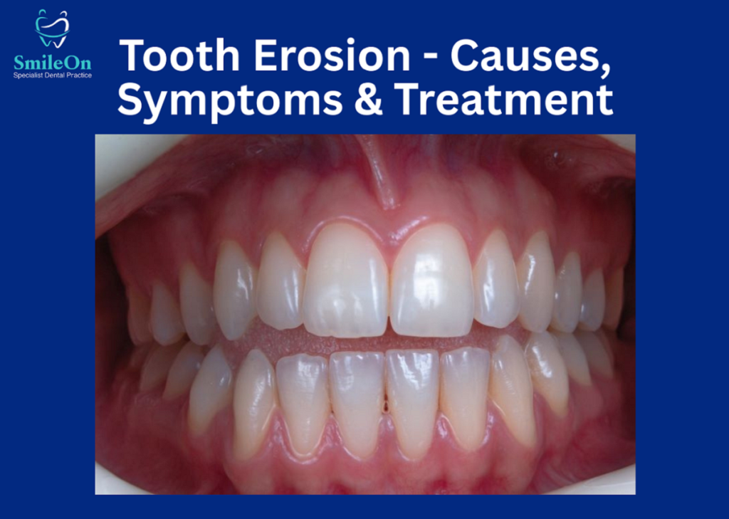 Tooth Erosion