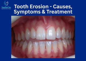 Tooth Erosion