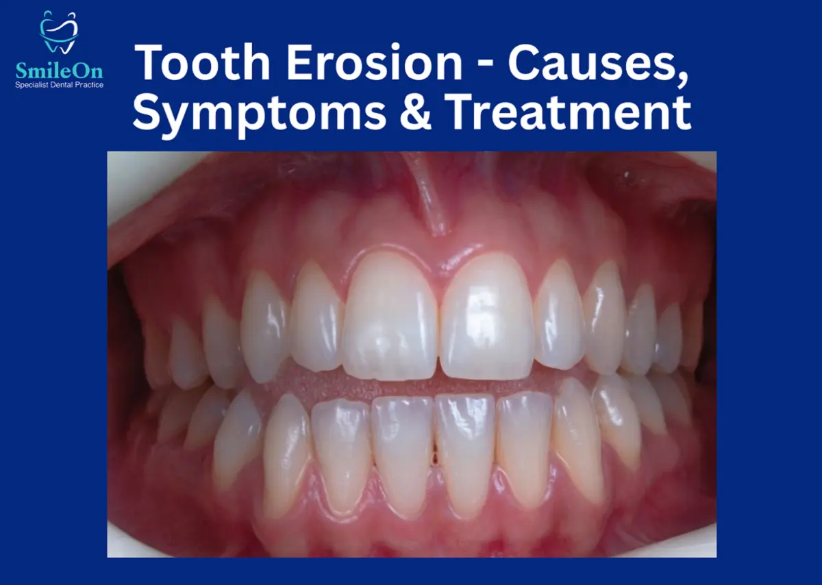 Tooth Erosion