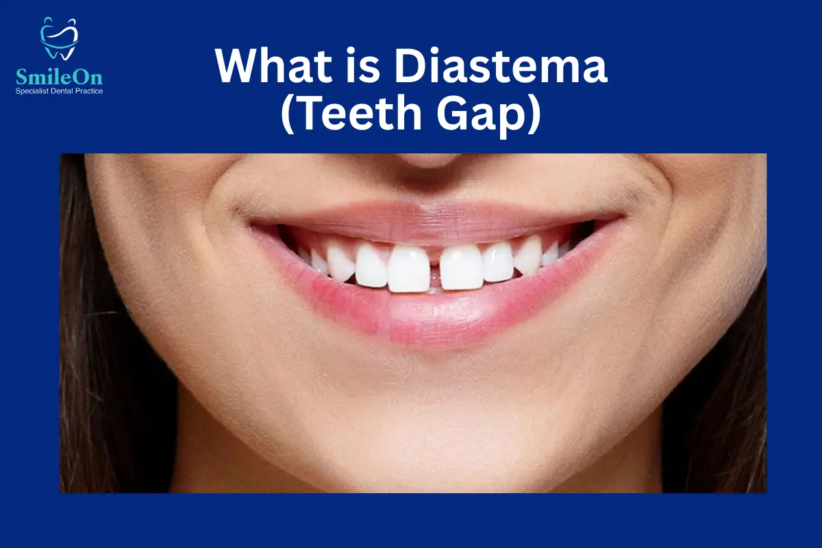 Diastema Teeth Gap