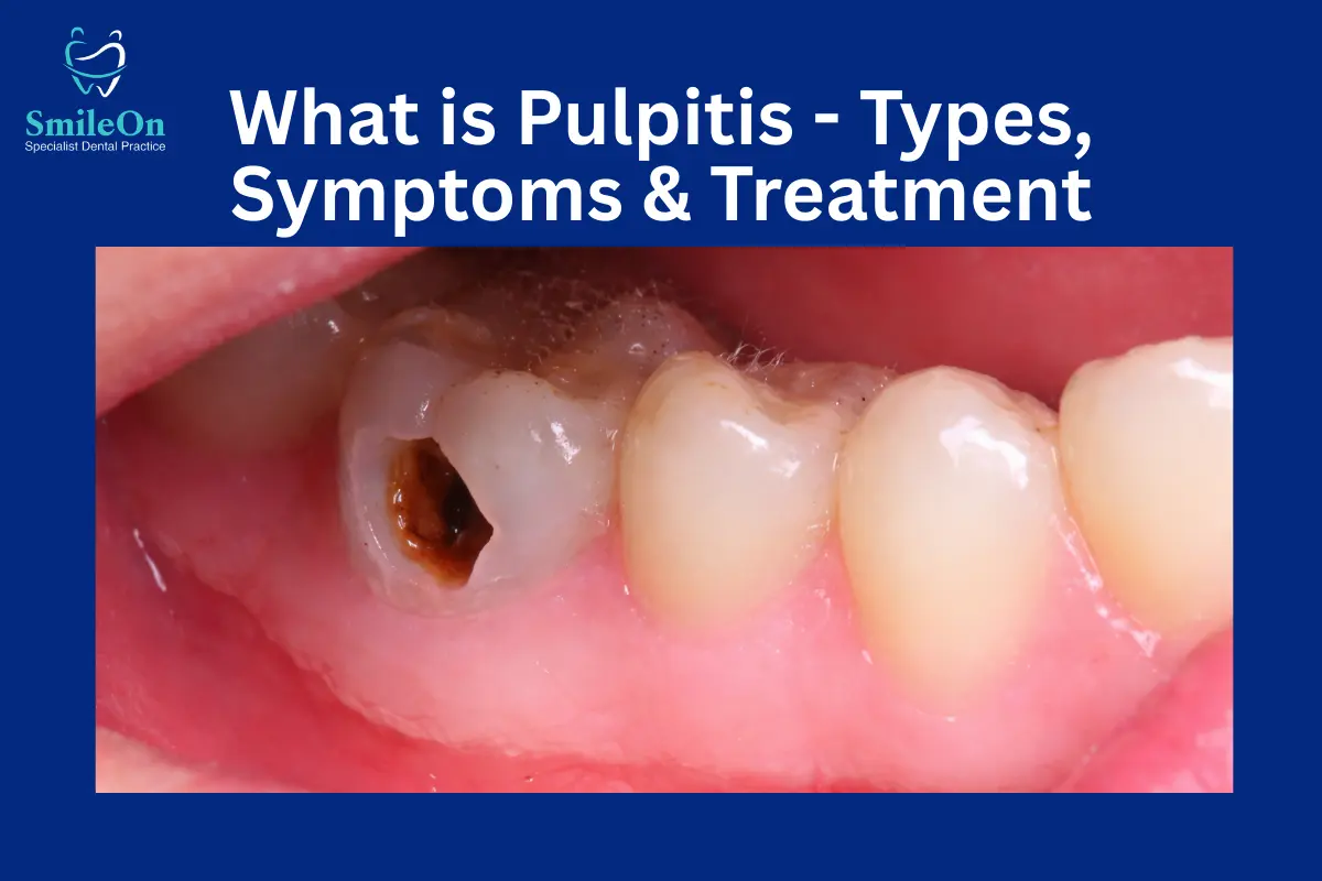 Pulpitis